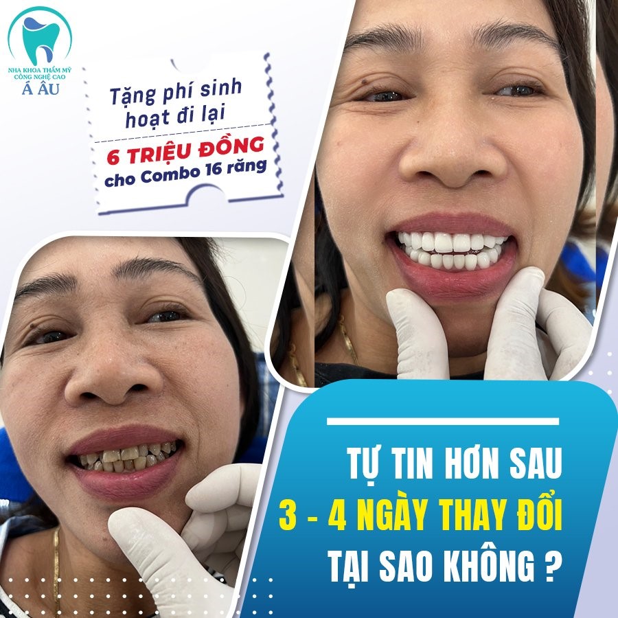 Bọc răng sứ tại nha khoa thẩm mỹ công nghệ cao Á Âu