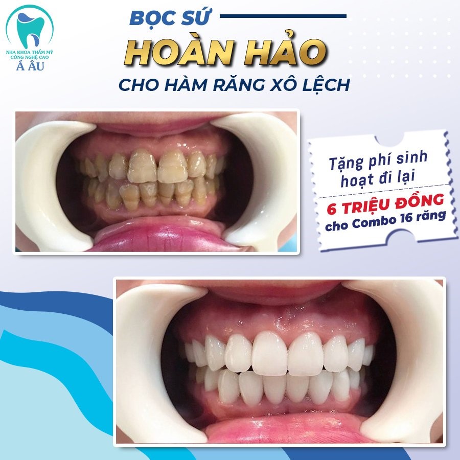 Nâng cấp nụ cười nhờ bọc răng sứ