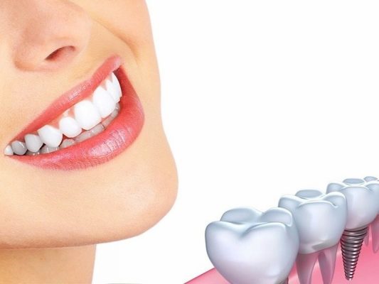 Cấy ghép implant là phương pháp bọc răng sứ hiện đại nhất hiện nay