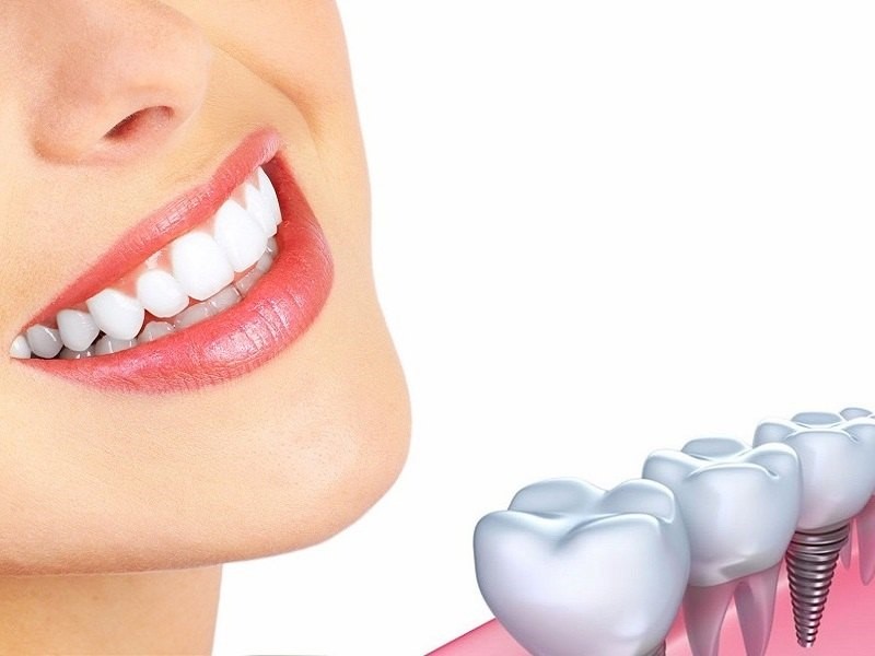 Cấy ghép implant là phương pháp bọc răng sứ hiện đại nhất hiện nay