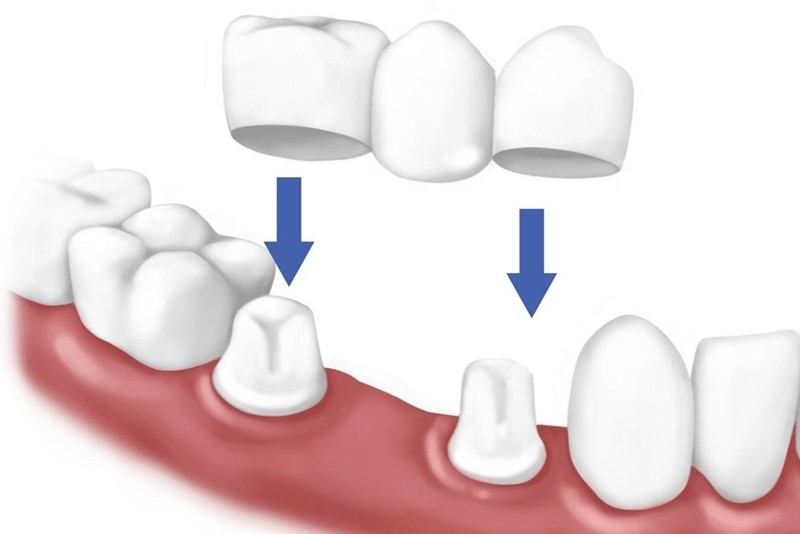 Phương pháp cầu răng sứ