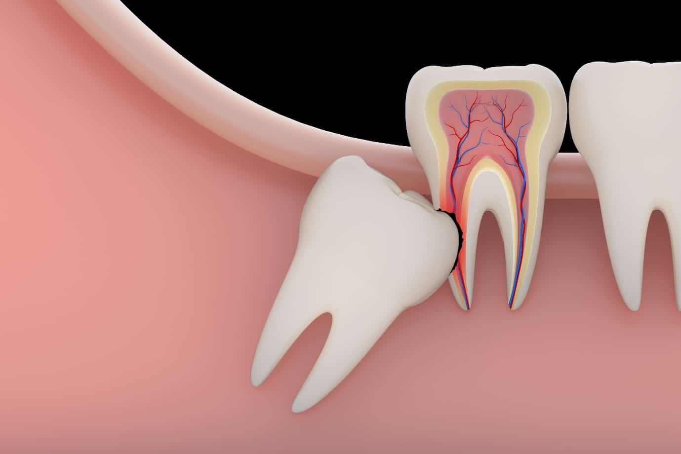 Đến nha khoa để được tư vấn về nhổ răng khôn