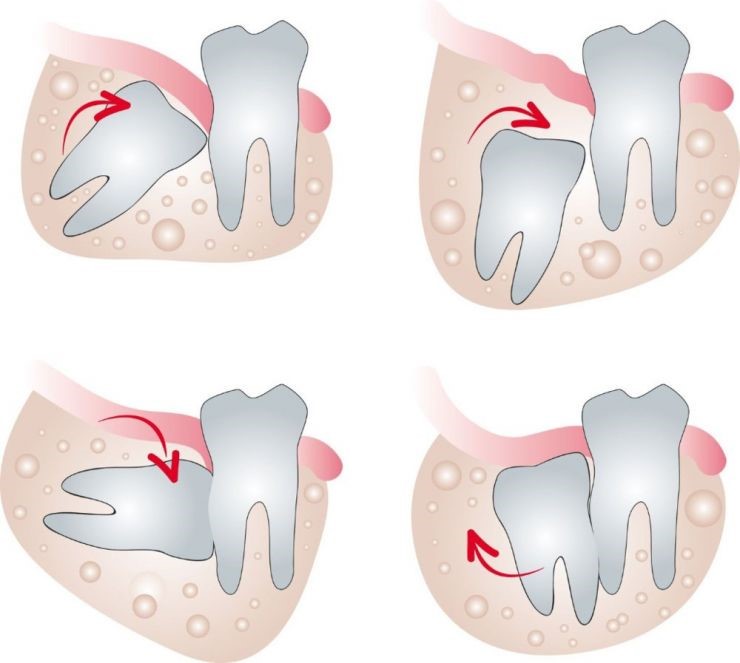 Nhổ răng khôn kịp thời để tránh các biến chứng