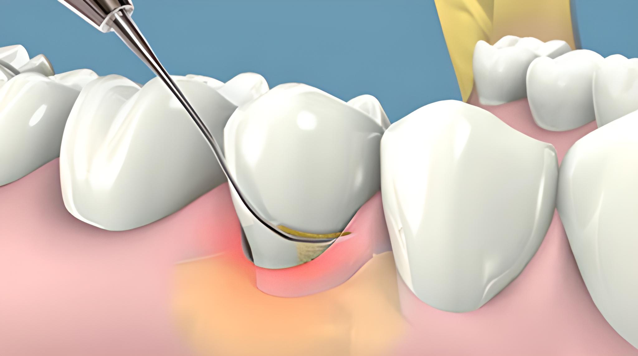 Lấy cao răng giúp răng khỏe mạnh, phòng chống bệnh răng miệng