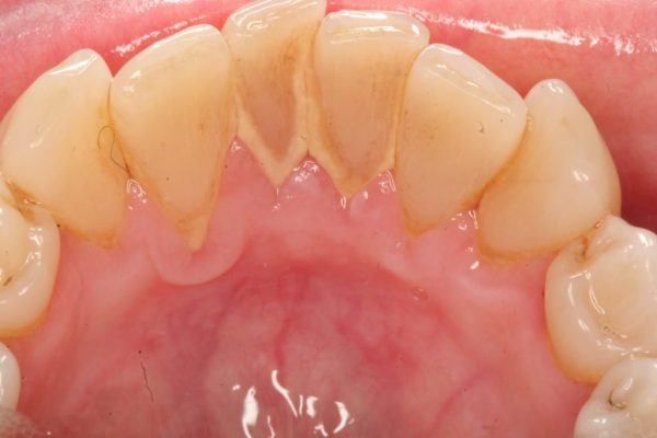 Cao răng xuất hiện là điều kiện thuận lợi cho các bệnh răng miệng