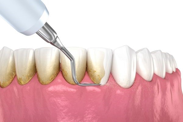 Lấy cao răng giúp răng miệng bạn sạch sẽ, thơm tho, ngăn ngừa nguy cơ gây bệnh răng miệng