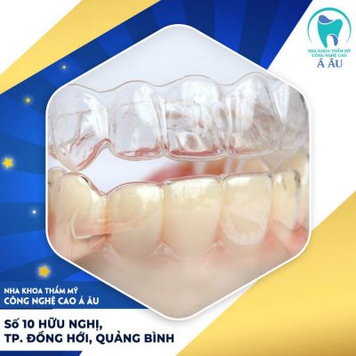 Niềng răng 3d clear liệu có hiệu quả như lời đồn tại nha khoa Á Âu?