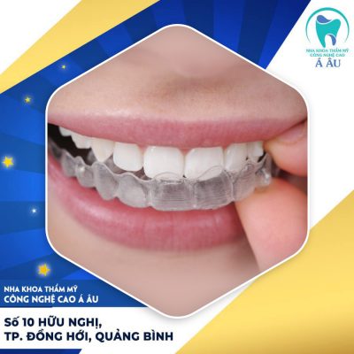 Khay niềng trong suốt chất lượng đem lại sự an toàn chỉnh nha