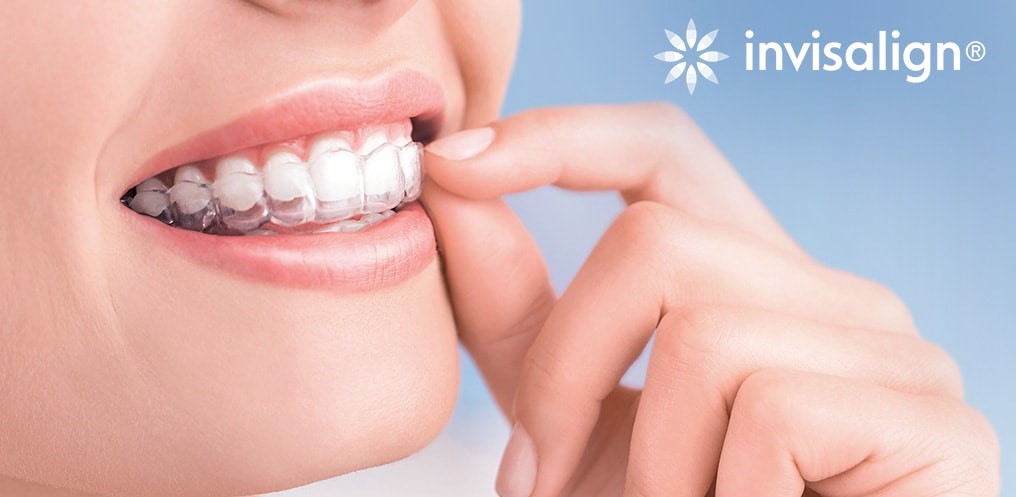 Niềng răng trong suốt Invisalign được dùng nhiều nhất hiện nay