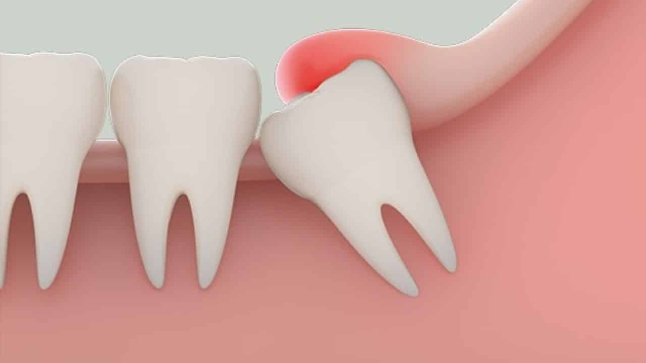 Răng khôn mọc lệch, nhầm cần có chỉ định nhổ bỏ