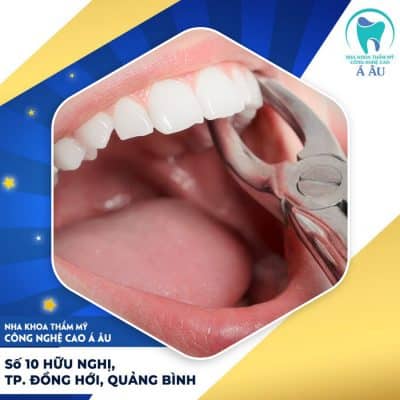 Nhổ răng ở nha khoa uy tín để tránh xảy ra tai biến