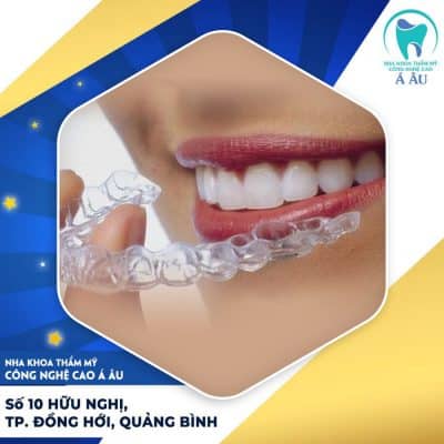 Lựa chọn vật liệu niềng răng chất lượng cao để đạt được hiệu quả tốt nhất