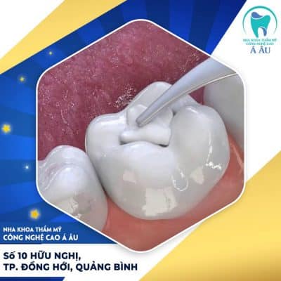 Trám răng sâu nặng có chi phí cao hơn những răng sau bình thường