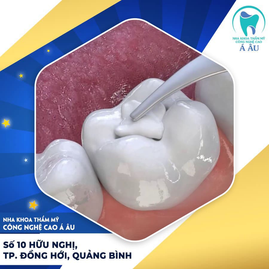 Trám răng sâu nặng có chi phí cao hơn những răng sau bình thường