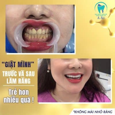 Bọc răng sứ đảm bảo hay không tùy vào nha khoa bọc thực hiện bọc sứ