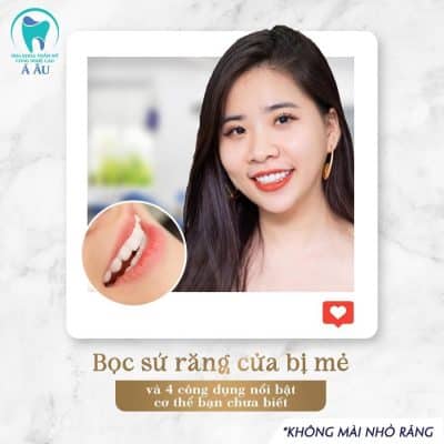 Bọc răng sứ có thể khắc phục các khuyết điểm của răng