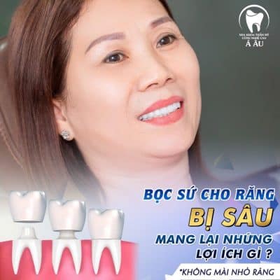 Bọc răng sứ cho răng bị sâu để bảo vệ răng và tăng thẩm mỹ