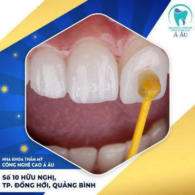 Dán sứ veneer có bền không phụ thuộc nhiều vào quy trình dán sứ