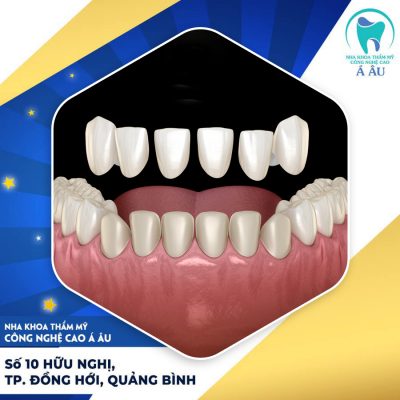 Dán sứ veneer có bị hôi miệng không?