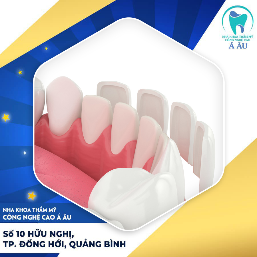 Các loại mặt dán sứ phổ biến trong nha khoa