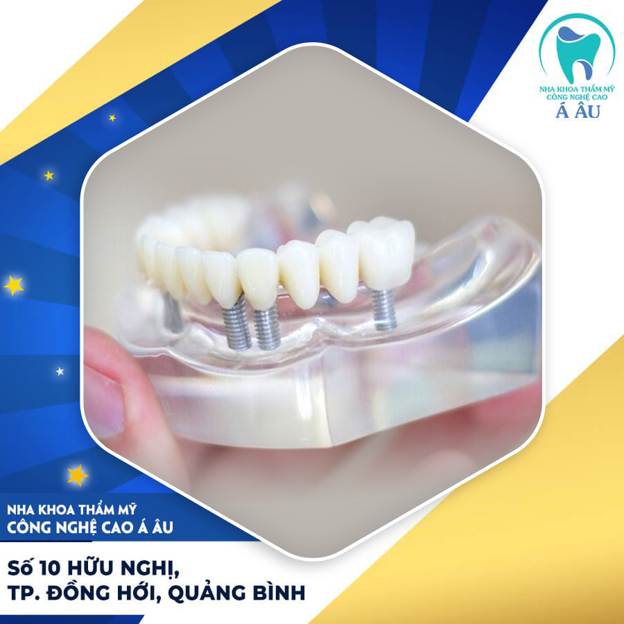 Các trường hợp nên bọc răng sứ titan