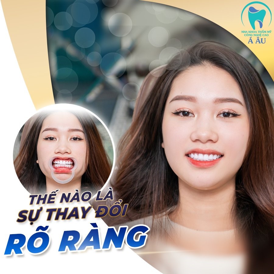 Răng sứ toàn sứ là sự lựa chọn hoàn hảo cho bọc răng sứ