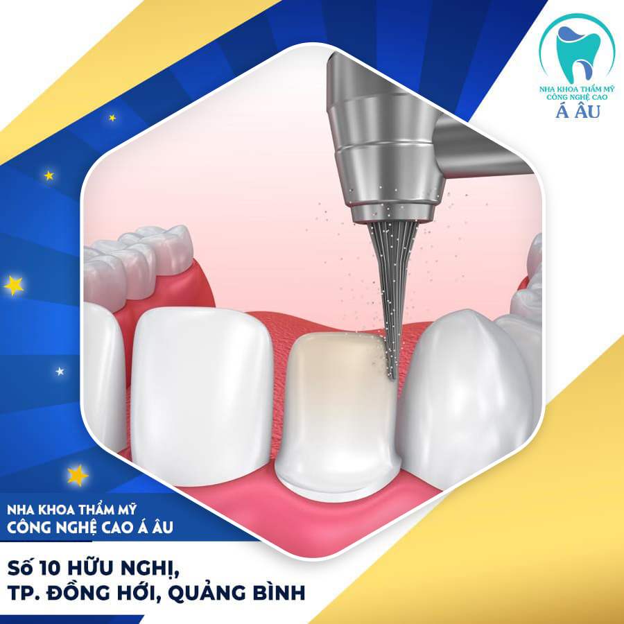 Bọc sứ mài ít là như thế nào?