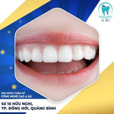 Làm 16 răng sứ giá bao nhiêu tiền phụ thuộc vào rất nhiều yếu tố