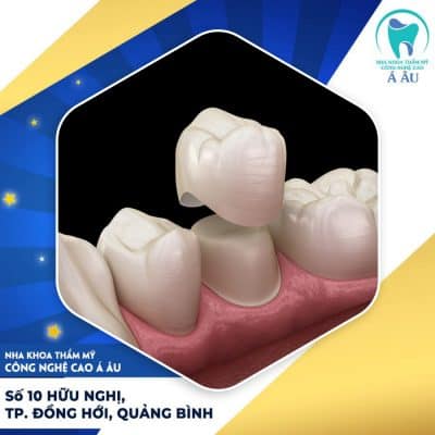 Răng sứ bán phần được kết hợp giữa kim loại và hợp chất sứ