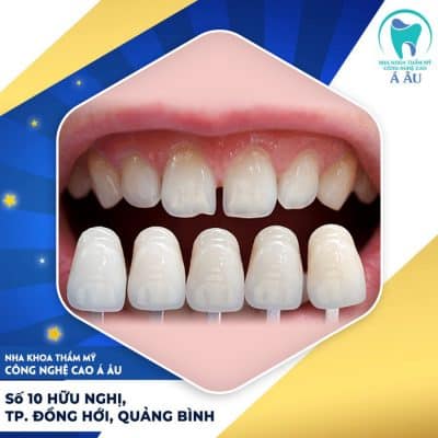 Dán sứ veneer không cần mài răng tiêu chuẩn