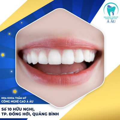 Làm 16 răng sứ giá bao nhiêu phụ thuộc vào rất nhiều yếu tố