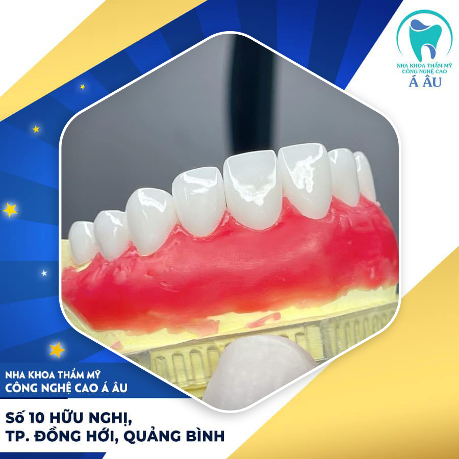 Loại răng sứ được sử dụng nhiều