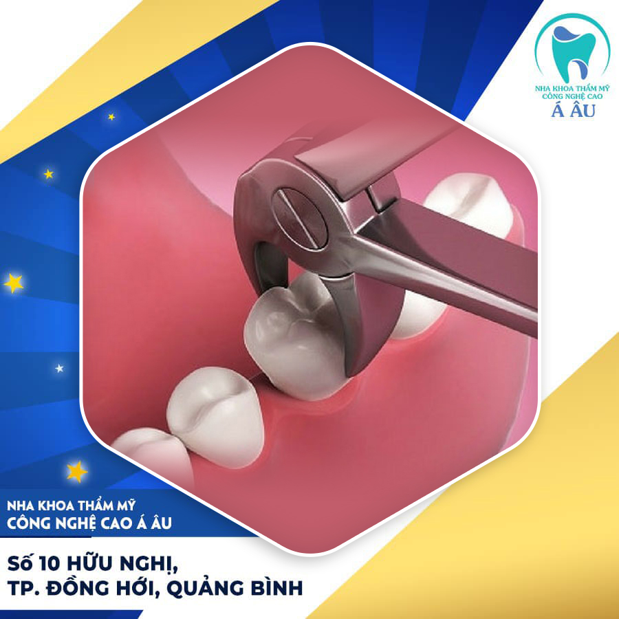 Nhổ răng sẽ không gây đau nếu được thực hiện tại nha khoa uy tín