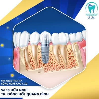 Cấy ghép implant được xem là một trong những giải pháp ưu việt trên thế giới