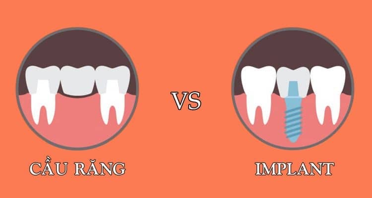 Nên lựa chọn trồng răng sứ hay làm răng sứ Implant?