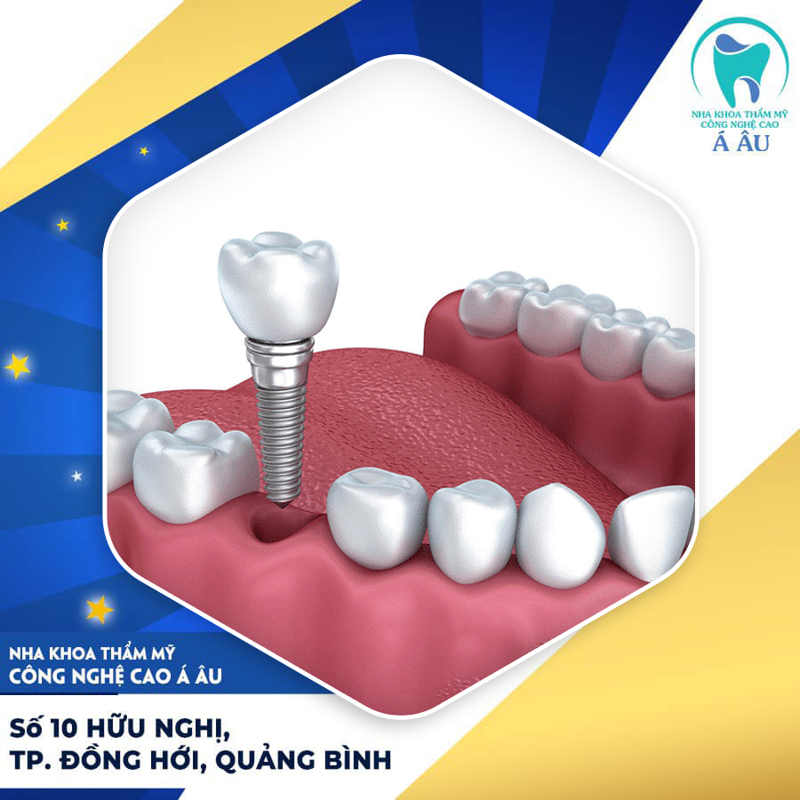 Quy trình cấy ghép Implant đòi hỏi chính xác cao