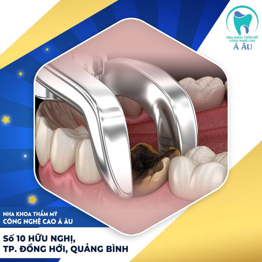 Khi nào nên thực hiện nhổ răng