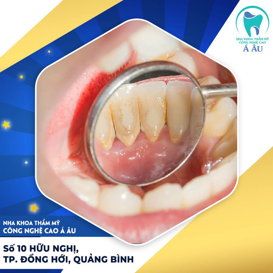 Phương pháp lấy cao răng hiện đại an toàn sẽ không gây cảm giác đau nhức