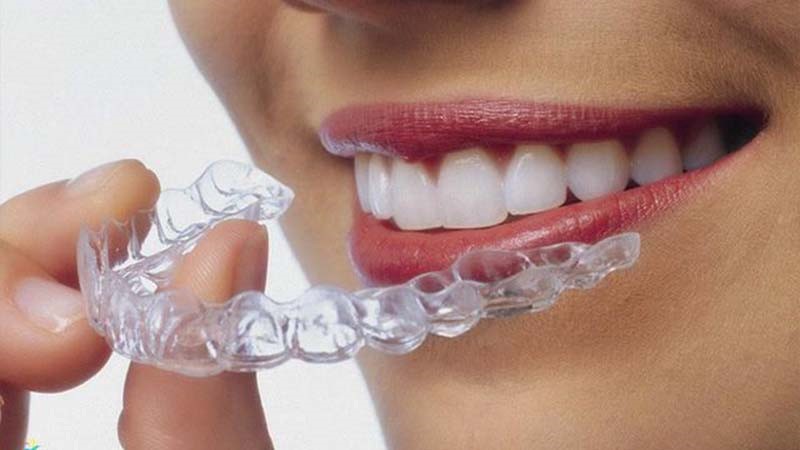 Lựa chọn vật liệu niềng răng chất lượng cao để đảm bảo hiệu quả