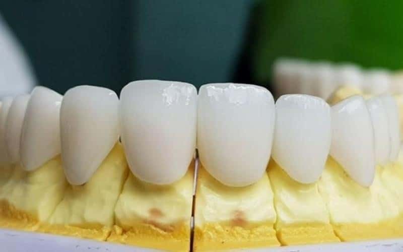 Răng sứ Zirconia là răng sứ Đức tốt hàng đầu hiện nay