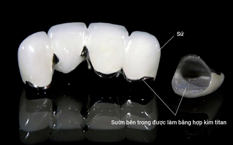 Răng sứ Mỹ là gì?