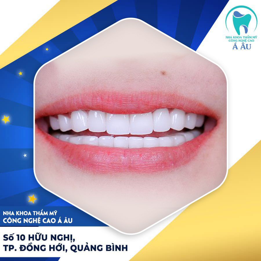 Nha khoa Á Âu – địa chỉ bọc răng sứ Mỹ được nhiều khách hàng tin tưởng