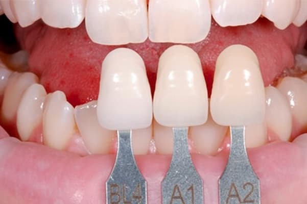 Chọn răng sứ theo màu răng thật để trong tự nhiên hơn