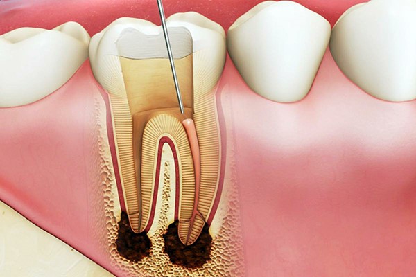 Quá trình lấy tủy sẽ không đau nếu thực hiện đúng cách