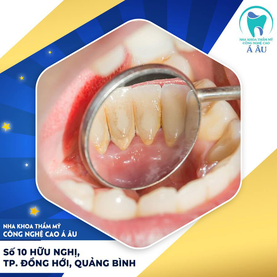 Phương pháp lấy cao răng hiện đại an toàn sẽ không gây đau đớn