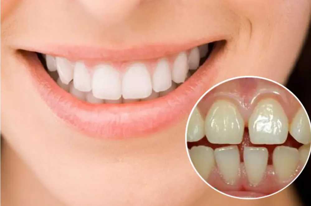 Làm răng sứ 4 răng cửa vừa tiết kiệm chi phí vừa mang lại nụ cười xinh