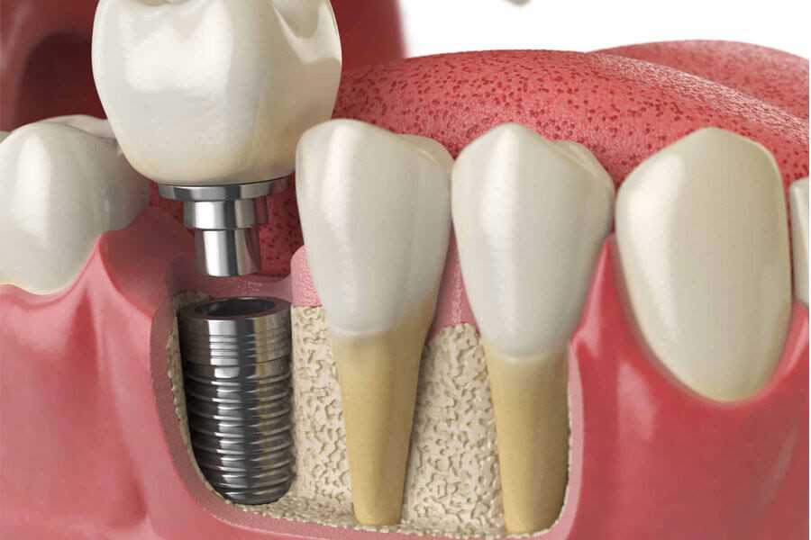 Mô hình cấy implant răng sứ