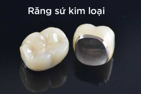 Hình ảnh của răng sứ kim loại