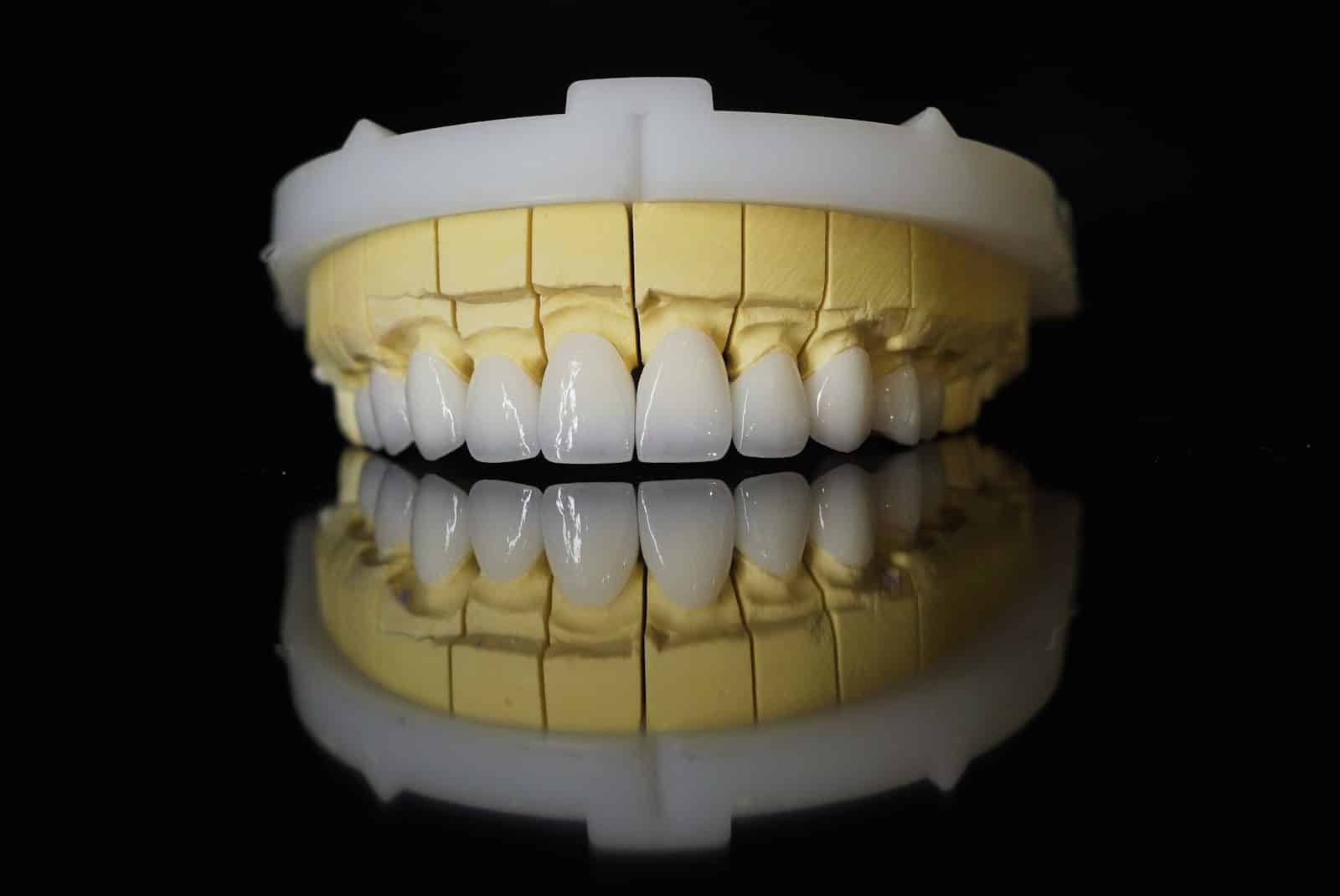 Cầu răng sứ không duy trì được vĩnh viễn được như trồng Implant