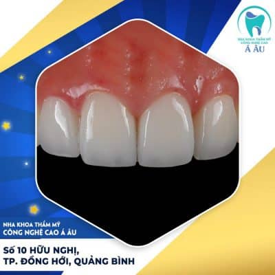 Răng sứ Nhật lành tính với cơ thể con người